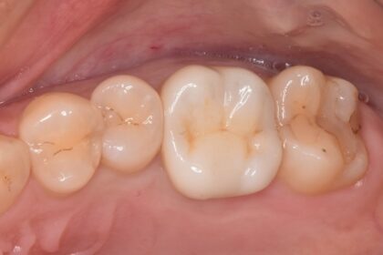 虫歯を精度の高いセラミックインレーで治療する