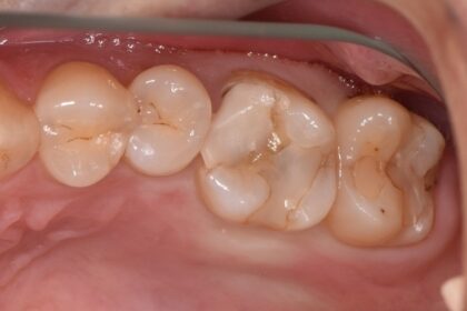 虫歯を精度の高いセラミックインレーで治療する